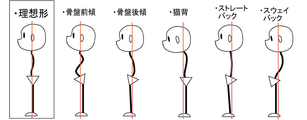 ストレートバック腰痛イラスト