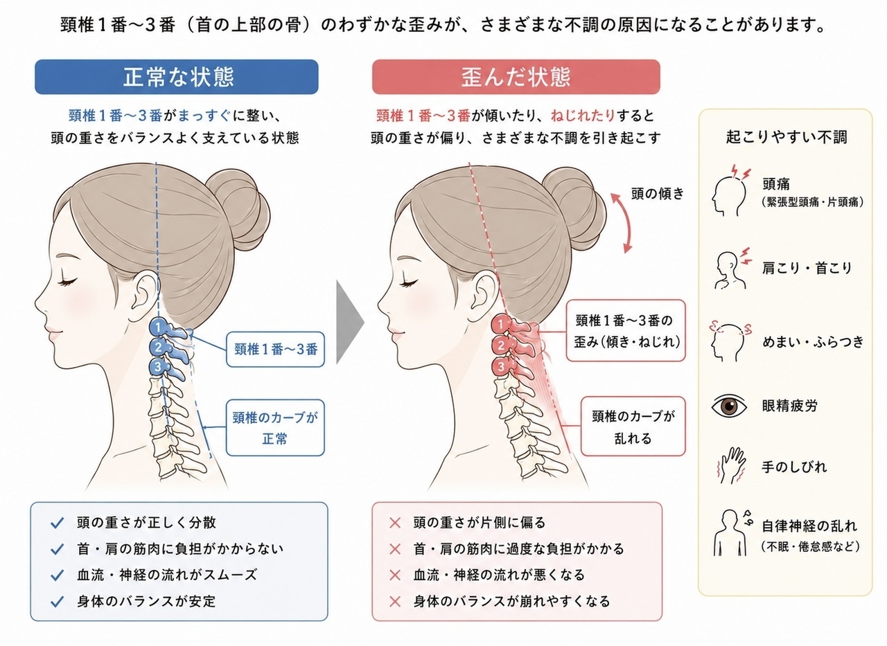 頚椎に歪みがあると頭痛になりやすい