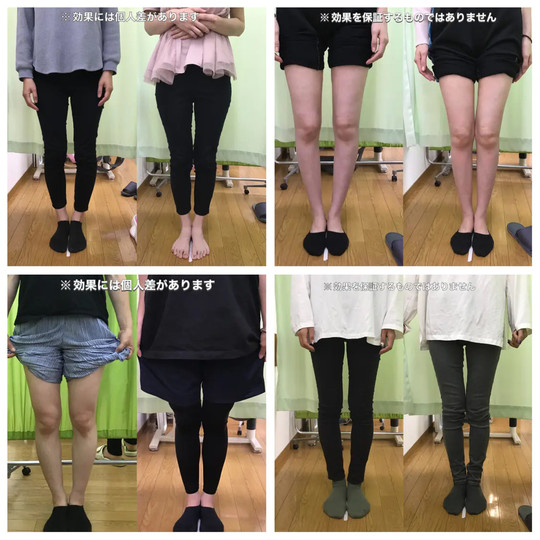 O脚矯正｜岡崎さくら整体院